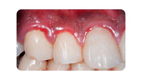gum regeneration summerlin nv